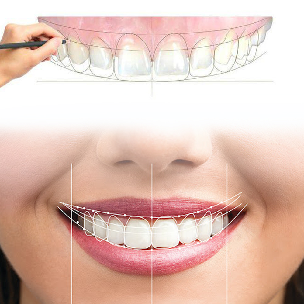Sourire esthétique avec Hollywood Smile